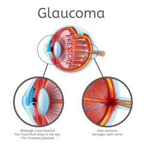 myopia glaucoma