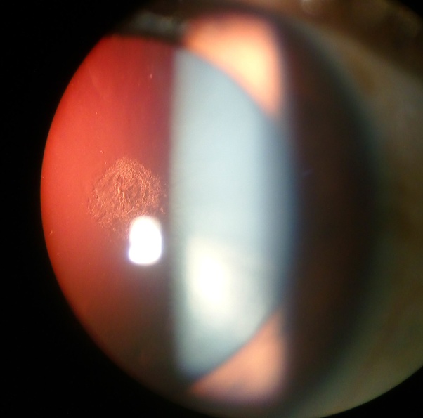 Posterior-Subcapsular-Cataract