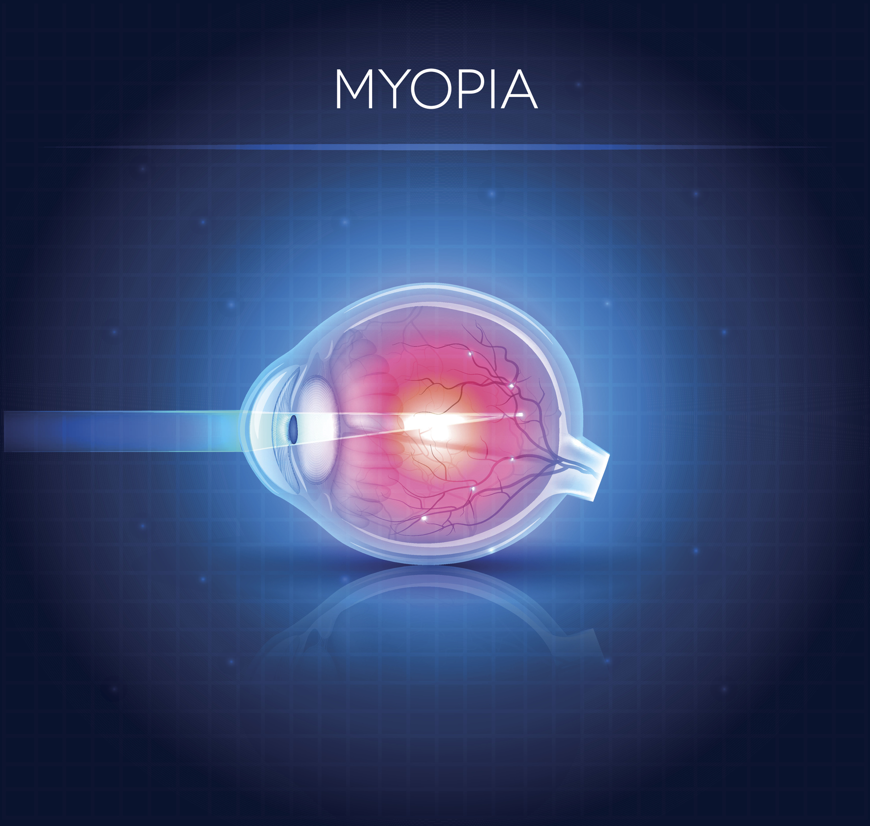 Myopia eyesight disorder