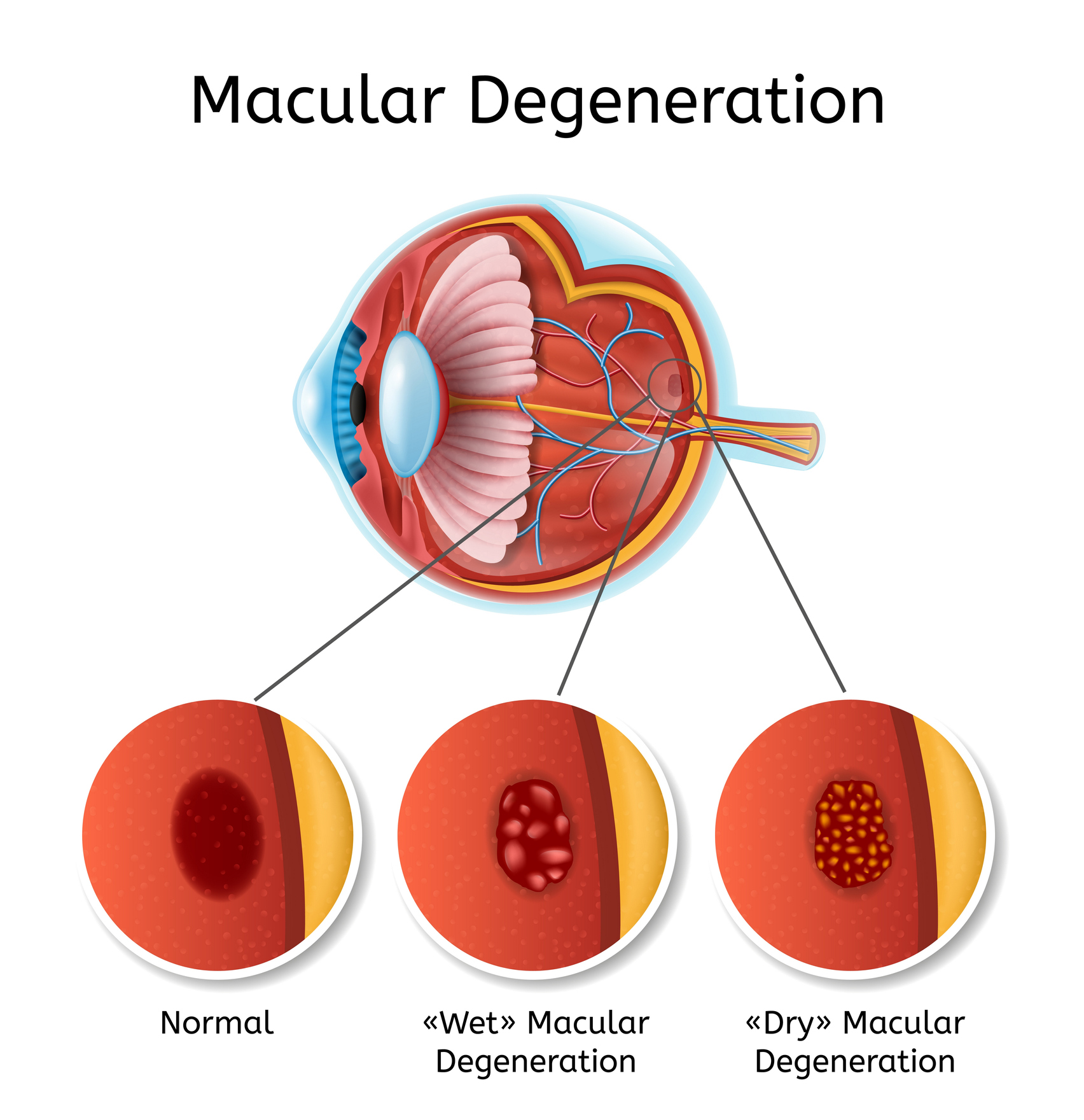 Myopic Maculopathy What Is It And How Is It Treated Review Of Myopia Management