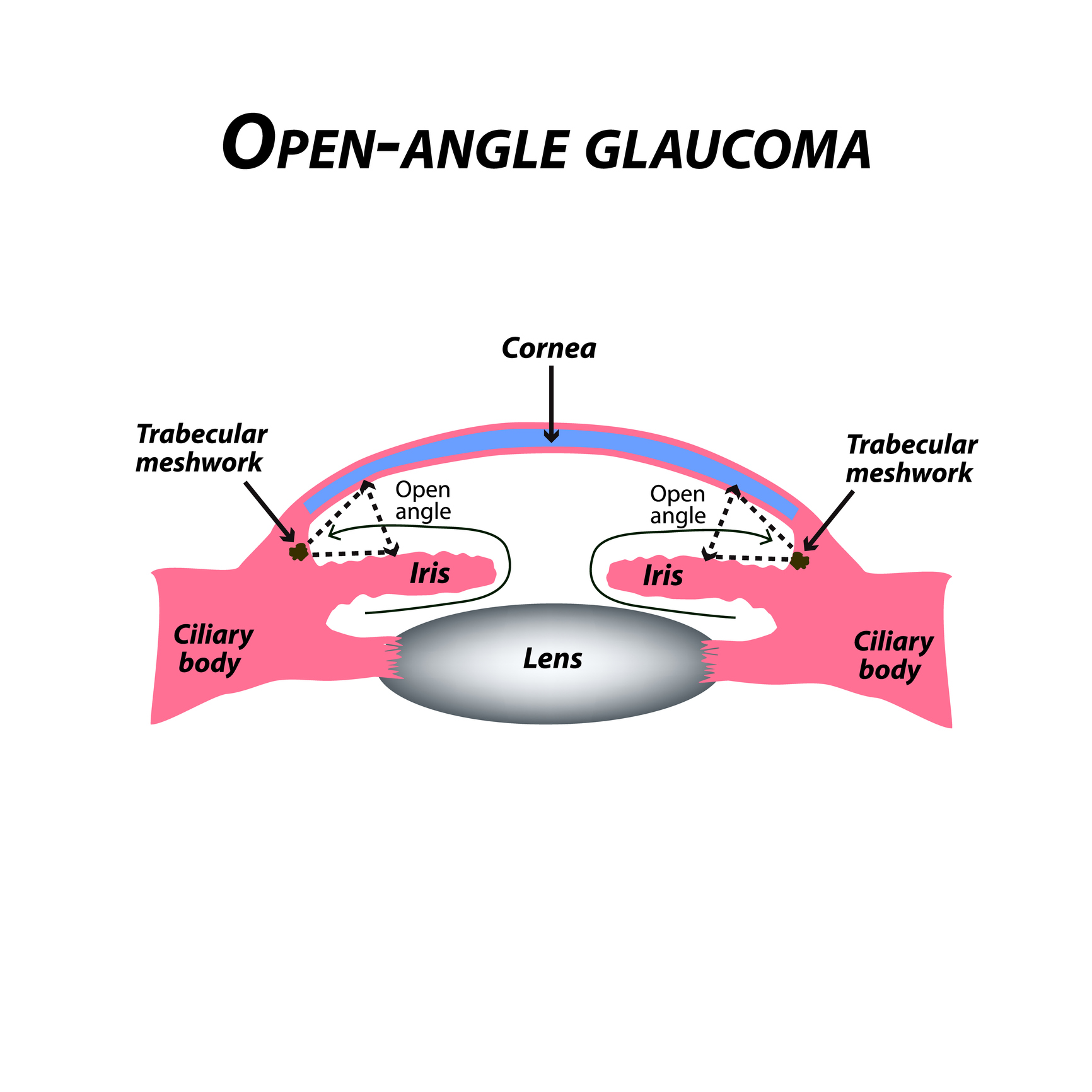 closed angle glaucoma vs open angle