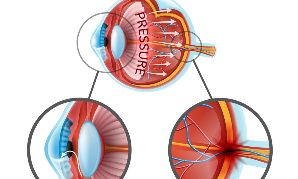 Myopia hyperopia and astigmatism explained
