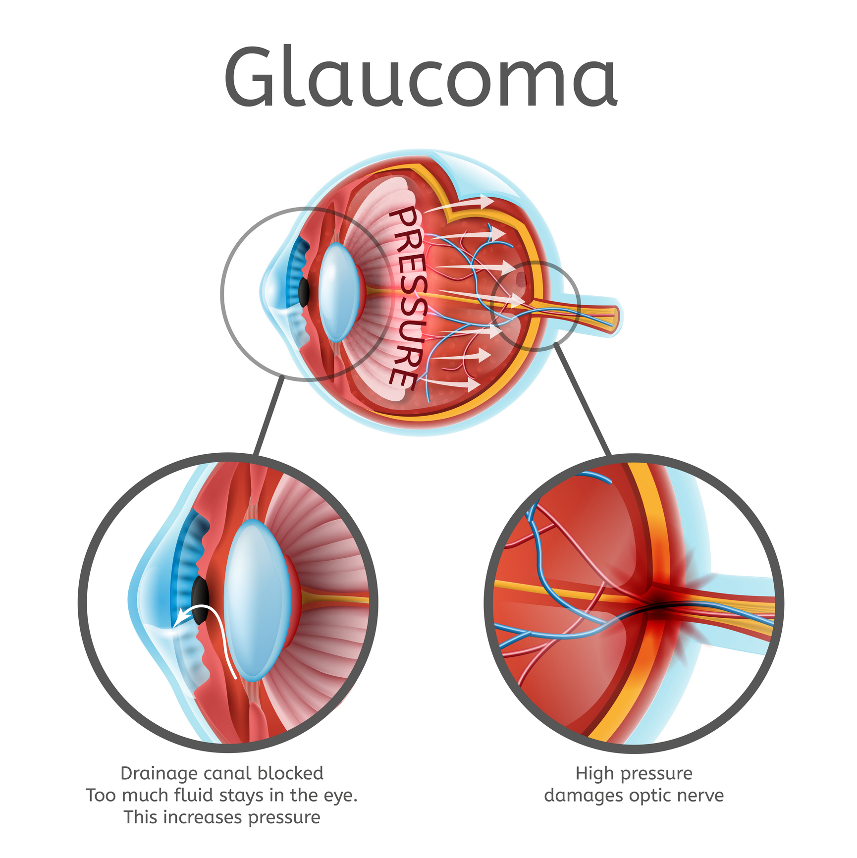 glaucoma-in-myopia-diagnostic-dilemmas-review-of-myopia-management