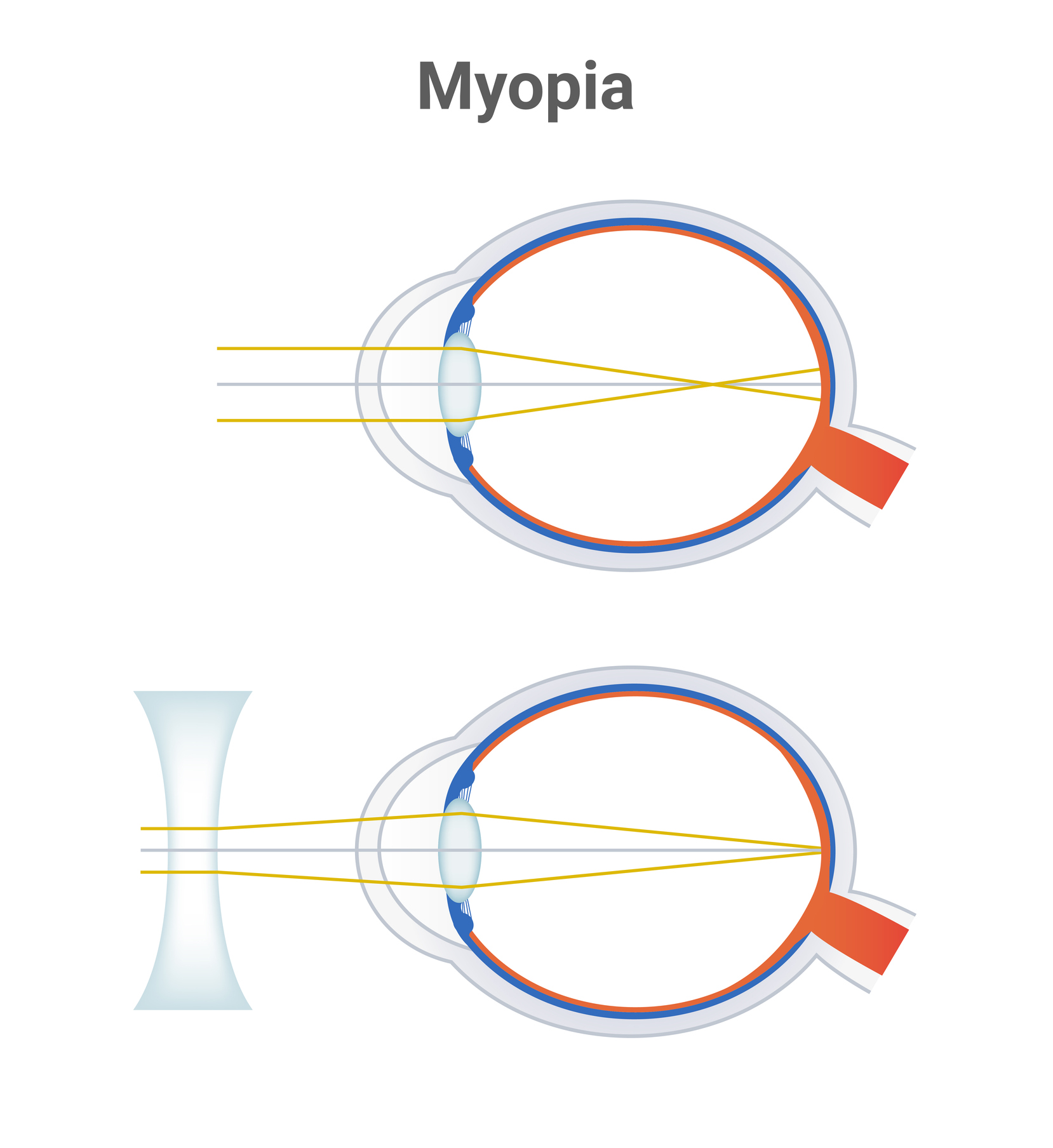 Myopia, short sightedness or near sightedness eye disorder and corrected eye by a minus lens or biconcave negative lens. The light is focused in front of the retina. Illustration is isolated on white