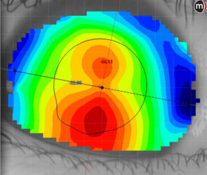 corneal topography in orthokeratology