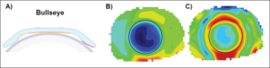 corneal topography in orthokeratology